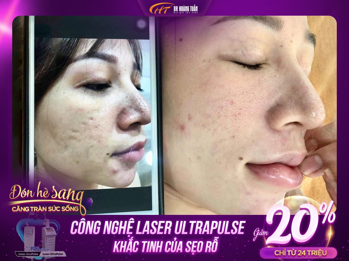 trị sẹo rỗ bằng laser có hết không